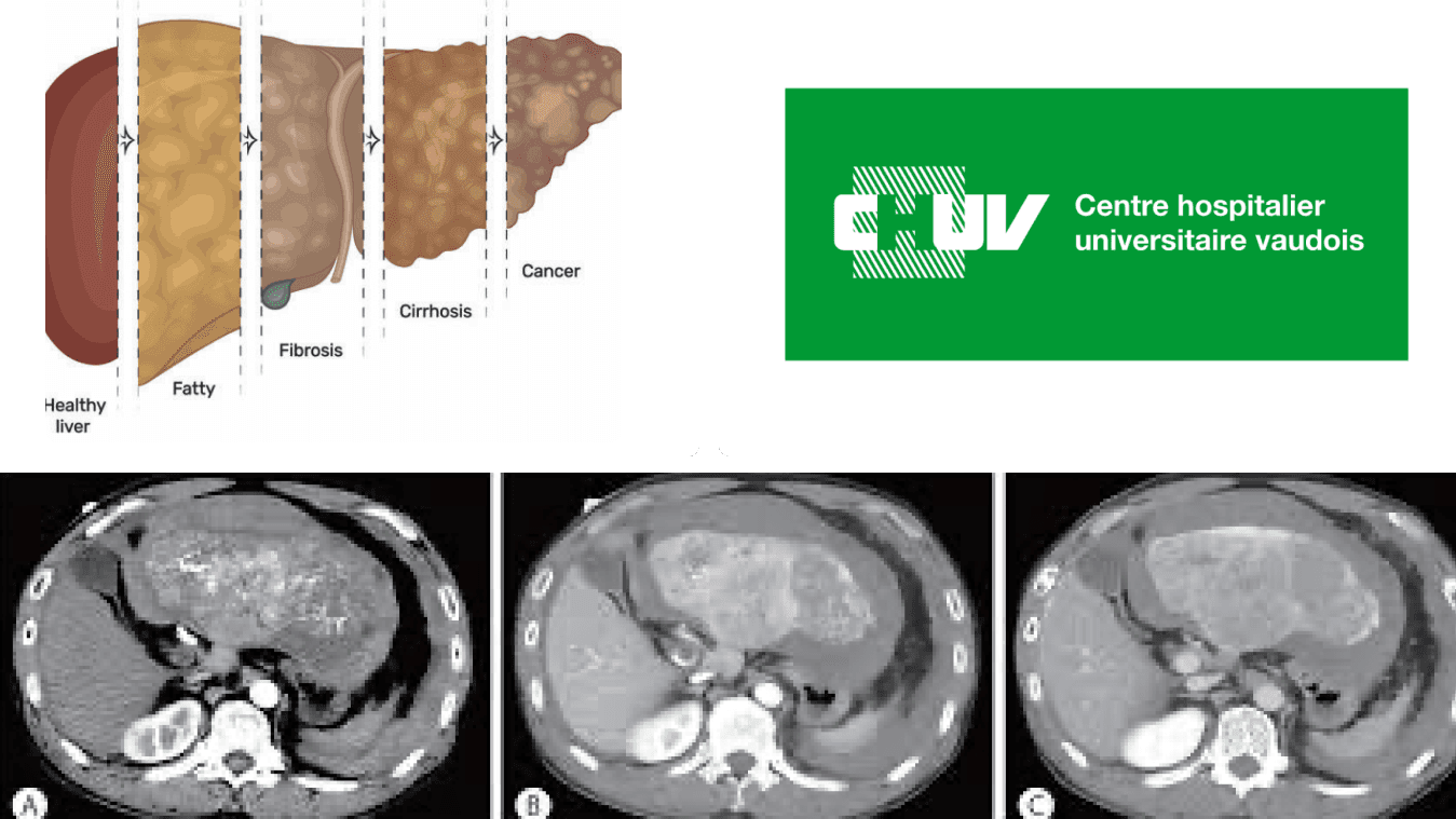 Inferring Prognosis for Macroscopic Hepatocellular Carcinoma